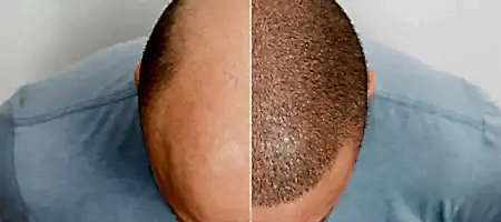 Hair Transplant 20% Off with E-pass